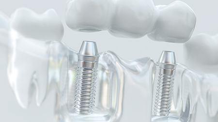 Model of three-unit dental implant bridge