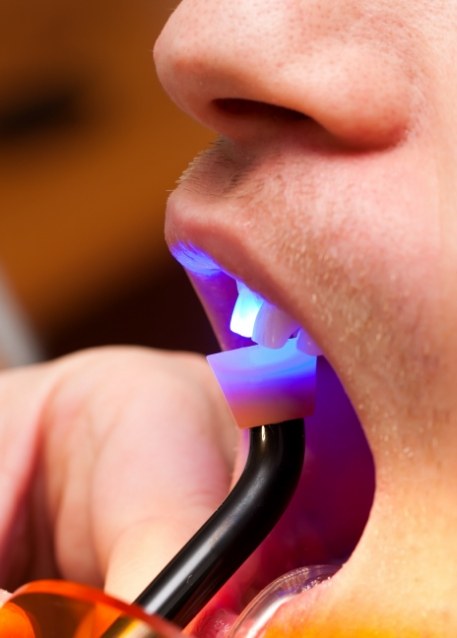 Close up of dental patient having ultraviolet light shone onto tooth