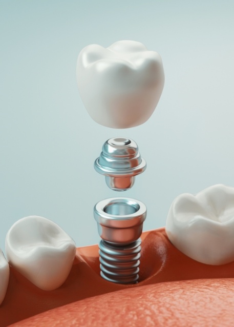 Illustrated model of a dental implant in Tampa