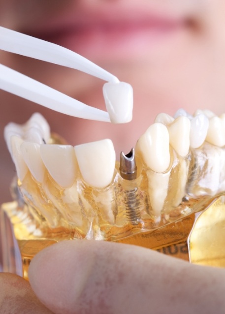 Dental crown being placed on model of a dental implant