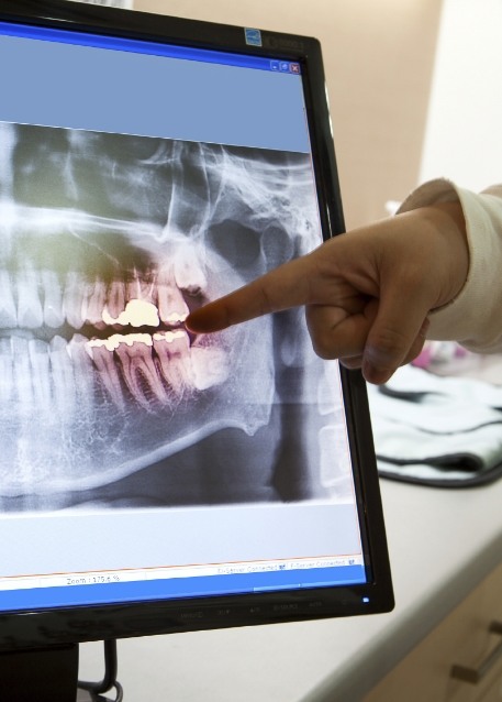 Dentist pointing to computer screen showing x ray of teeth