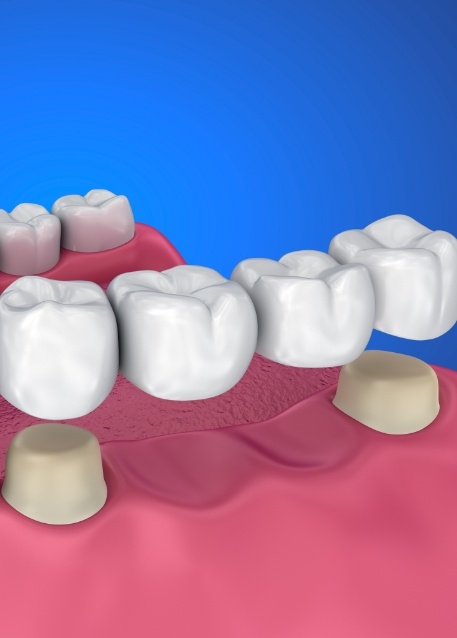 Illustrated dental bridge replacing two missing teeth in Tampa