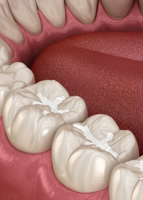 Illustrated close up of teeth with white fillings