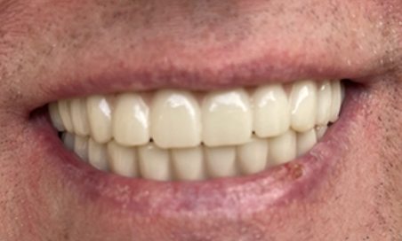 Close up of smile with complete arches of teeth