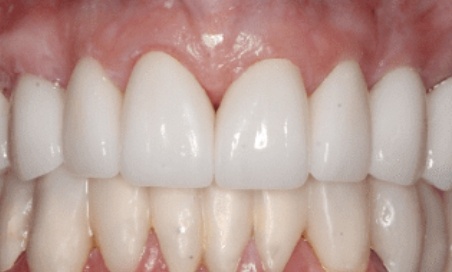Close up of mouth with full arches of white teeth