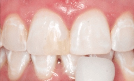 Mouth after treating discolored and gapped teeth