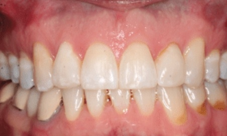 Mouth with evenly aligned teeth after orthodontic treatment