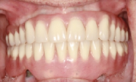 Mouth after treating slightly damaged teeth
