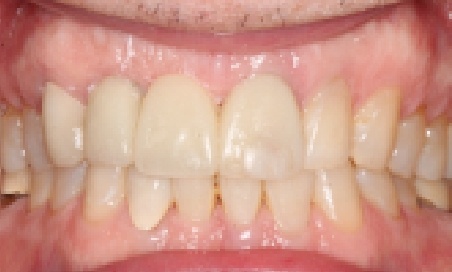 Mouth after treating gapped teeth