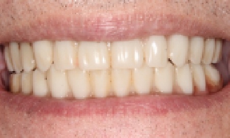 Mouth after correcting discolored and gapped teeth