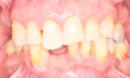 Close up of smile missing one lower tooth