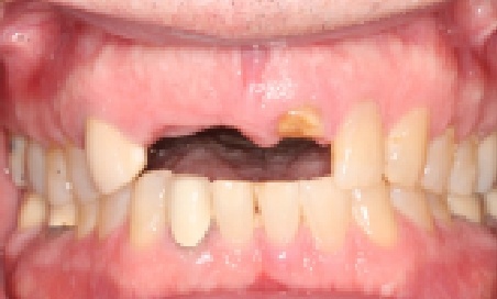 Close up of mouth missing a few upper teeth
