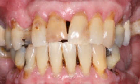 Mouth with several discolored and gapped teeth