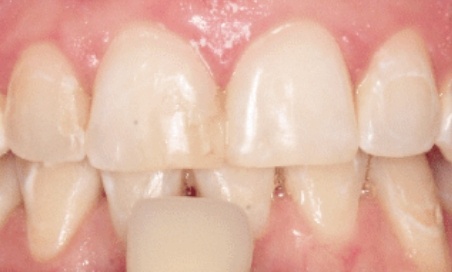 Mouth with slightly damaged teeth