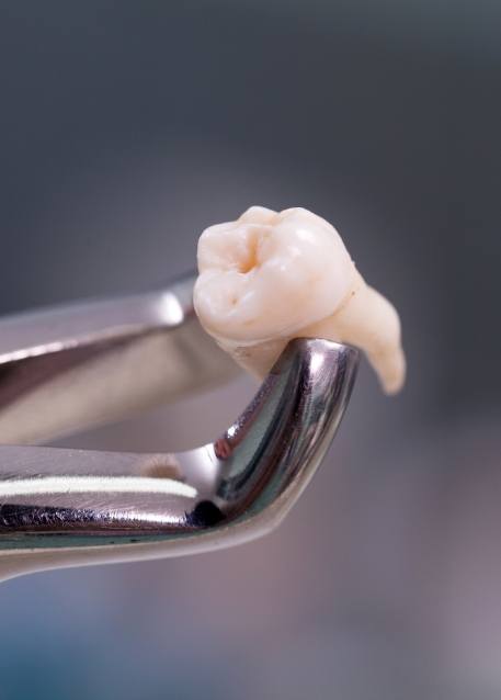 Dental clasp holding an extracted tooth